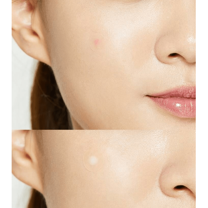 COSRX Acne Pimple Master Patch (24 patches)